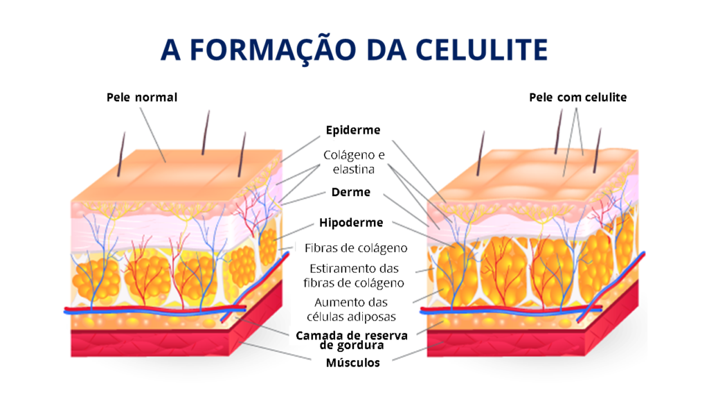 Camadas da pele mostrando o comparativo entre uma pele normal e uma pele com celulite.